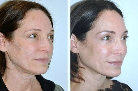 Full-face Non-surgical Facial Lift suppliers